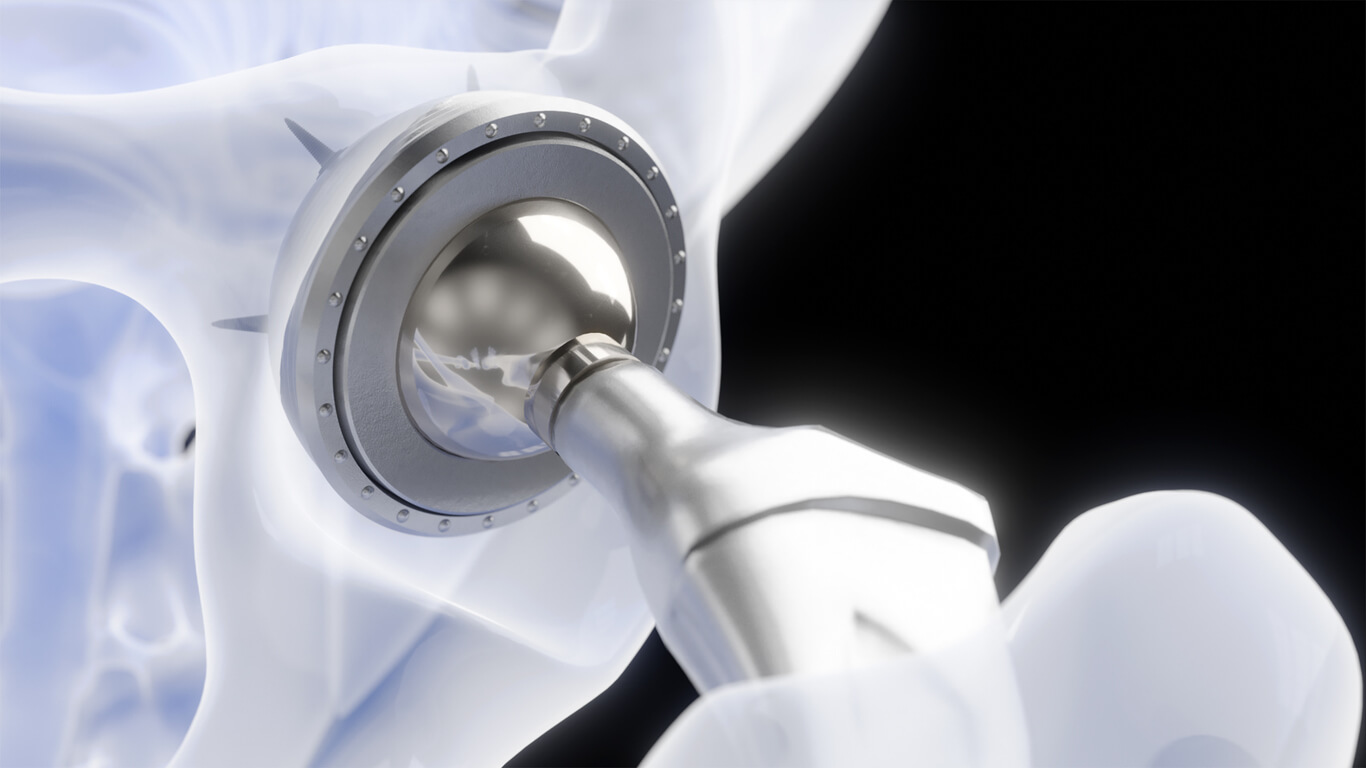 Total hip replacement surgery in Mumbai by Dr. Vinay Joshi