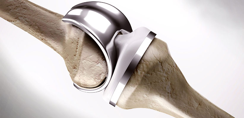 Total knee replacement surgery in Mumbai by Dr. Vinay Joshi